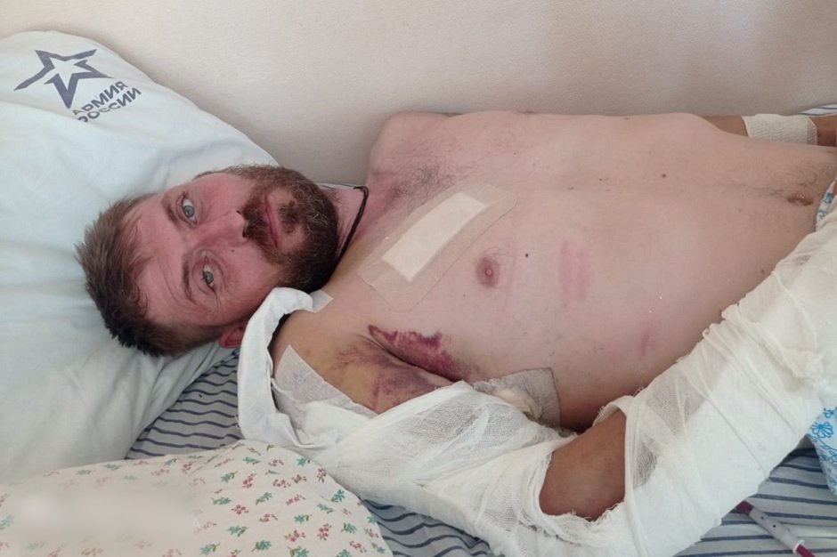 Под Бахмутом военнослужащий получил тяжелое ранение во время взрыва, его парализовало, отказала левая рука