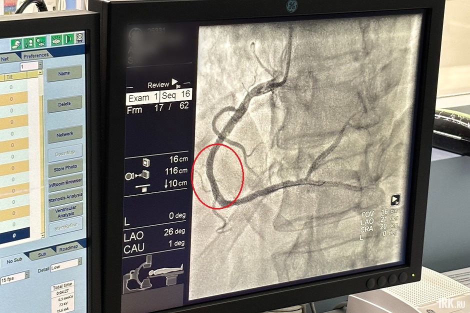 Эта же артерия после процедуры стентирования. Фото IRK.ru