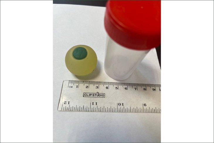 Силиконовый глаз. Фото минздрава Челябинской области