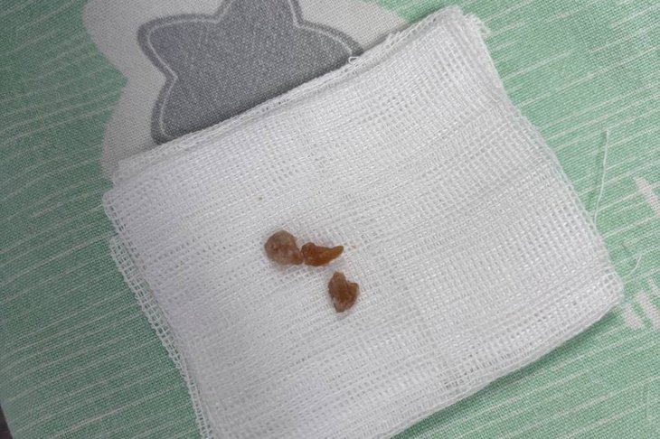 Кусочек арахиса, который удалили из легкого малыша. Фото из телеграм-канала Юрия Козлова