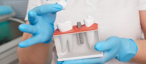 Популярные мифы об имплантации и протезировании зубов: так ли это больно и страшно?